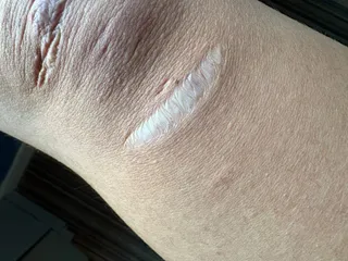 Wide, sunken atrophic scar with thin, wrinkled surface on skin