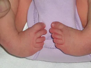 Infant foot turned inward and downward at the ankle