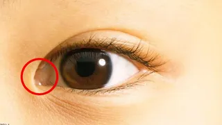 Eyes showing skin folds covering the inner corners