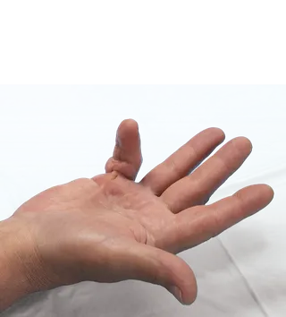 A finger joint held in a permanently bent position