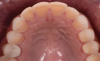 Inner surfaces of upper teeth showing worn, eroded enamel