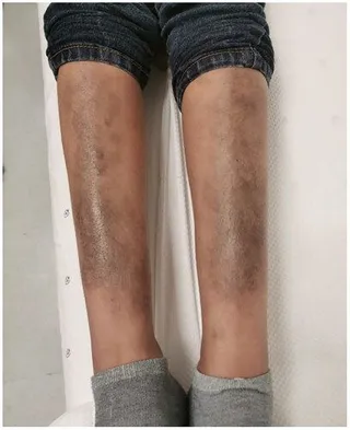 Firm, discolored raised patches over the front of the shins