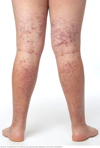 Purple-red spots and patches under the skin