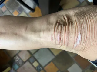 Loose folds of extra skin over the knuckles of a hand