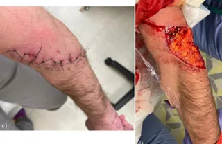 A split in fragile skin exposing the deeper tissue beneath