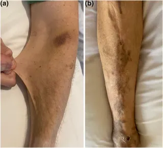 Skin on the forearm being pulled outward to show how far it stretches