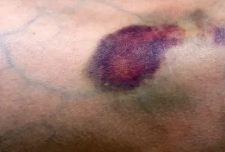 A large, dark, raised collection of blood beneath the skin